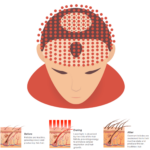 Lasercap_2.png